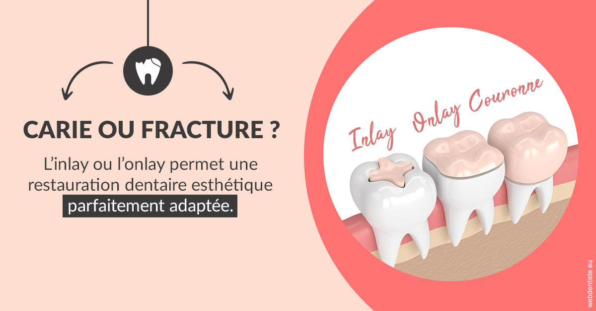 https://dr-charles-graindorge.chirurgiens-dentistes.fr/T2 2023 - Carie ou fracture 2