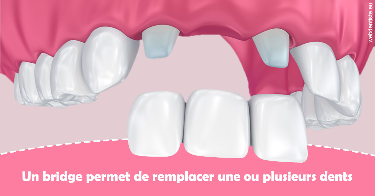 https://dr-charles-graindorge.chirurgiens-dentistes.fr/Bridge remplacer dents 2