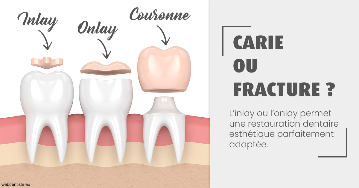 https://dr-charles-graindorge.chirurgiens-dentistes.fr/T2 2023 - Carie ou fracture 1