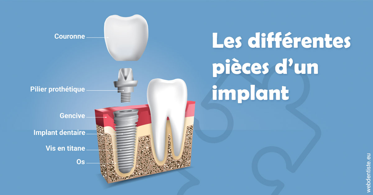 https://dr-charles-graindorge.chirurgiens-dentistes.fr/Les différentes pièces d’un implant 1
